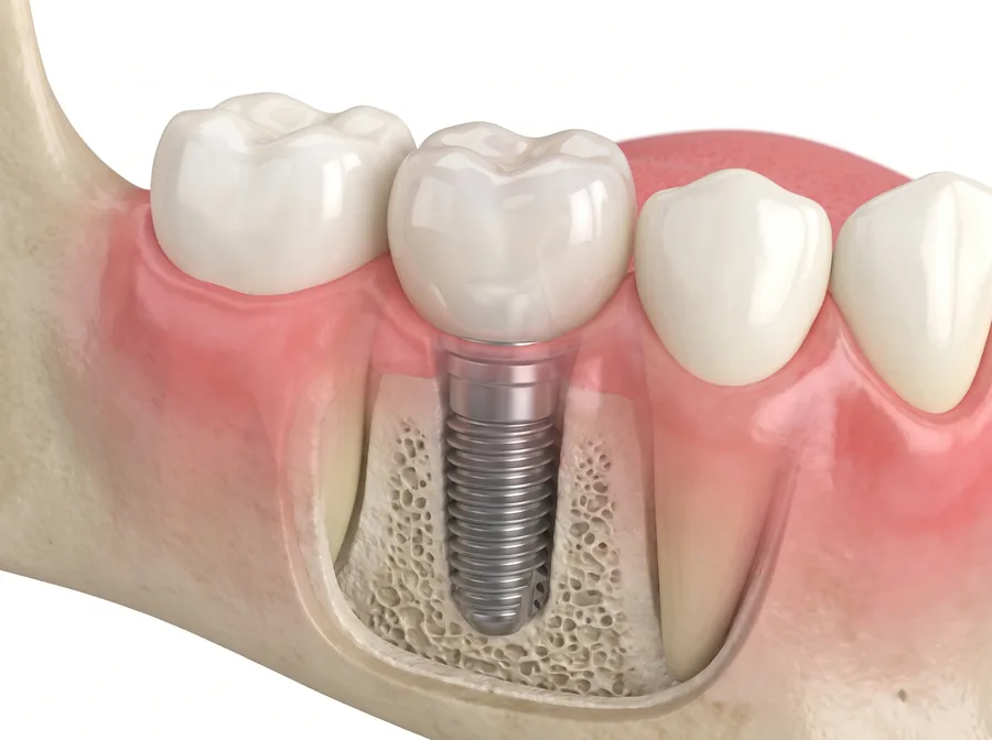 Single dental implant replacing a missing tooth between two natural teeth
