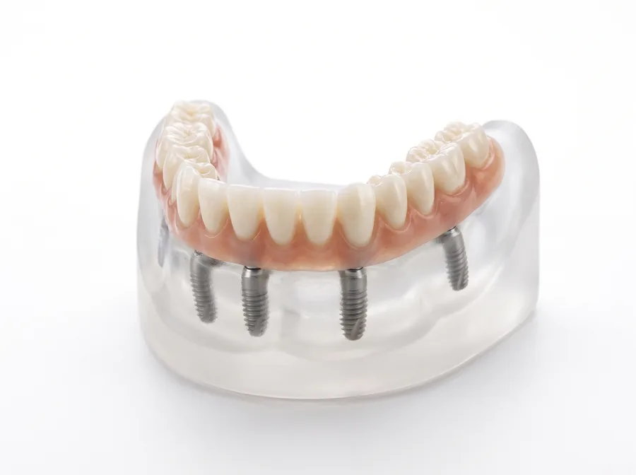 Complete dental arch fixed on four implants