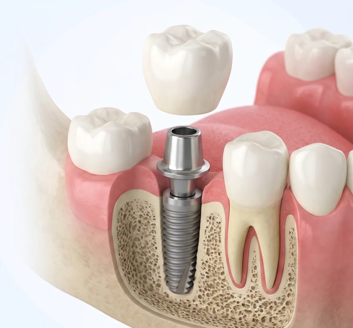 Implant dentaire en coupe : vis en titane dans l'os, pilier au-dessus de la gencive et couronne en céramique